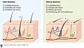 Schematische Darstellung des Aufbaus der Haut. Eitrige Infektionen: Akne, Follikulitis, Furunkel, Karbunkel.