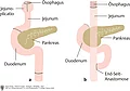 Darstellung zu Wiederherstellung der Nahrungspassage nach Gastrektomie: a. Jejunuminterponat mit Jejunoplicato; b. Roux-Y-Verfahren.