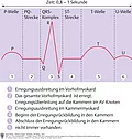 Grafische Darstellung des Herzzyklus im normalen EKG mit P-Welle, PQ-Strecke, QRS-Komplex, ST-Strecke, T-Welle, U-Welle.