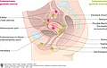 Weiblicher Genitaltrakt von der Seite (Sagittalschnitt) mit Befallsmuster bei Endometriose (Endometriosis genitalis interna und externa).