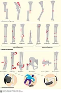 Übersicht zu Frakturformen an verschiedenen Knochen. Einteilung nach Dislokation, Verlauf der Frakturlinien und Entstehungsmechanismus.