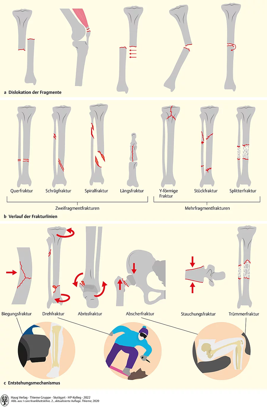 Übersicht zu Frakturformen an verschiedenen Knochen. Einteilung nach Dislokation, Verlauf der Frakturlinien und Entstehungsmechanismus.