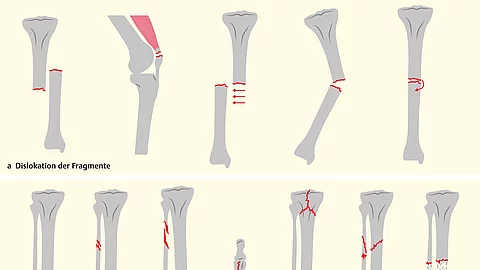 Übersicht zu Frakturformen an verschiedenen Knochen. Einteilung nach Dislokation, Verlauf der Frakturlinien und Entstehungsmechanismus.