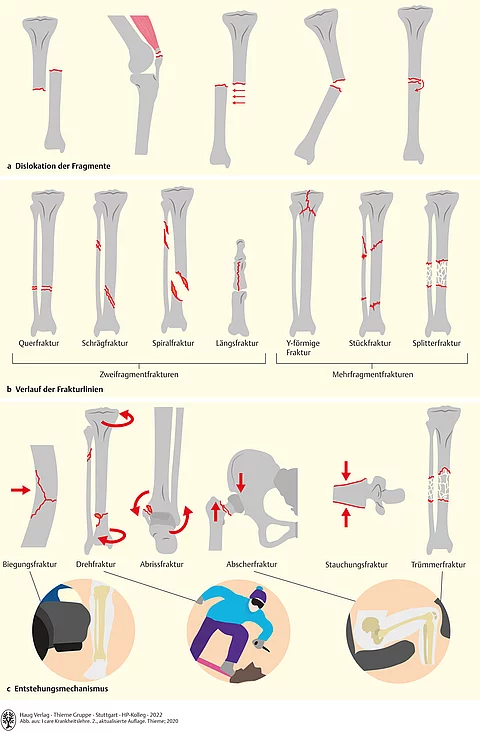 Übersicht zu Frakturformen an verschiedenen Knochen. Einteilung nach Dislokation, Verlauf der Frakturlinien und Entstehungsmechanismus.