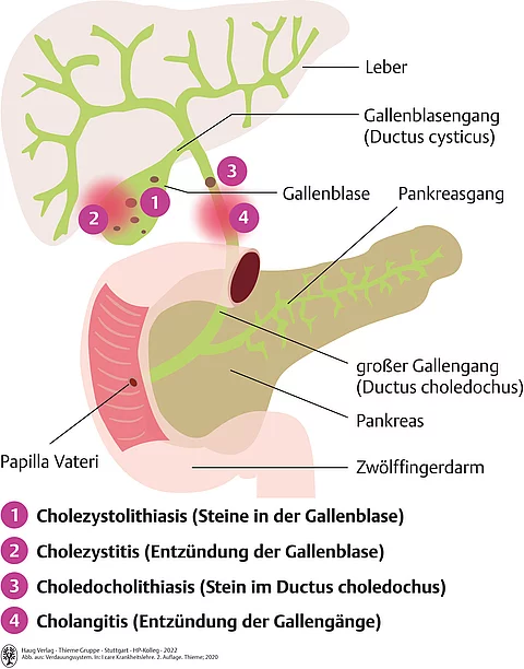 Anatomische Zeichnung Leber, Galle, Bauchspeicheldrüse und wo Erkrankungen wie Cholelithiasis, Cholezystitis und Cholangitis lokalisiert sind. 