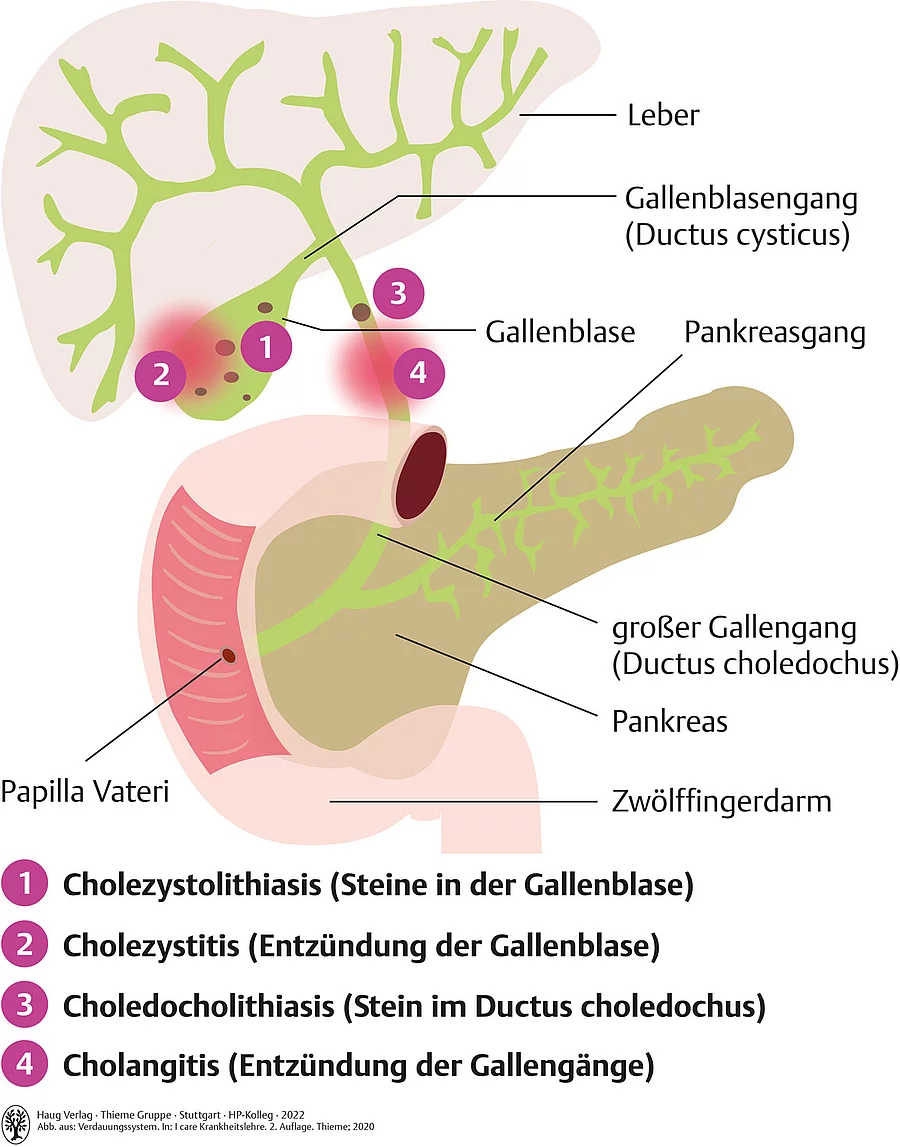 Anatomische Zeichnung Leber, Galle, Bauchspeicheldrüse und wo Erkrankungen wie Cholelithiasis, Cholezystitis und Cholangitis lokalisiert sind. 