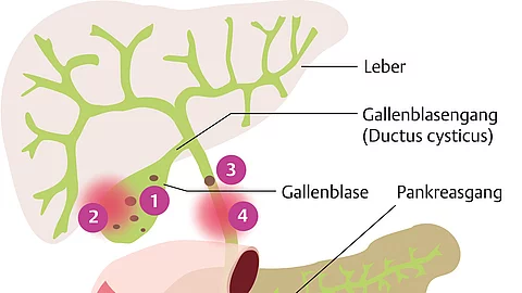 Anatomische Zeichnung Leber, Galle, Bauchspeicheldrüse und wo Erkrankungen wie Cholelithiasis, Cholezystitis und Cholangitis lokalisiert sind. 