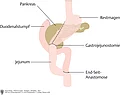 Schematische Darstellung Pankreas, Restmagen, Duodenalstumpf, Jejunum bei Roux-Y-Anastomose.