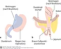 Schamtische Darstellung des Magens und angrenzenden Darmbereichen nach Magenresektion nach a. Billroth 1 und b. Billroth 2