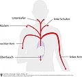 Oberkörper und Kopf von vorne mit Darstellung der ausstrahlenden Schmerzen bei Angina pectoris.