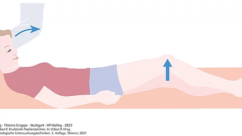 Mensch in Rückenlage mit positivem Brudzinski-Zeichen: Bei Vorbeugen des Kopfes werden reflektorisch die Knie gebeugt.