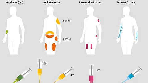 Grafische Darstellung der 4 Injektionsarten intrakutan, subkutan, intramuskulär und intravenös und der dazugehörigen Injektionsstellen am Körper. 