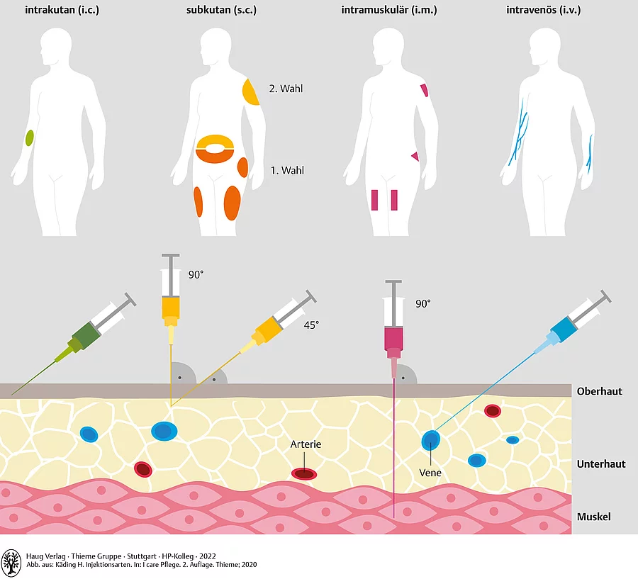 Grafische Darstellung der 4 Injektionsarten intrakutan, subkutan, intramuskulär und intravenös und der dazugehörigen Injektionsstellen am Körper.