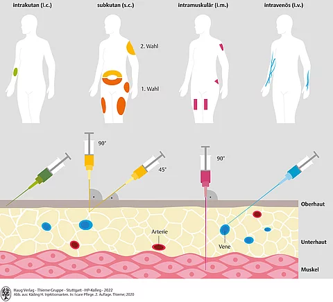 Grafische Darstellung der 4 Injektionsarten intrakutan, subkutan, intramuskulär und intravenös und der dazugehörigen Injektionsstellen am Körper. 