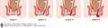 Schematische Darstellung Anusbereich und 4 Stadien des Hämorrhoidalleidens.
